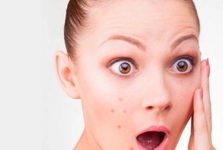 Lazerle Akne Tedavisi