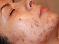 Sivilce ve Akne Temizleme Yöntemleri