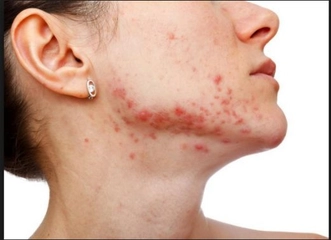 Akne Hastalığı Belirtileri ve Tedavisi