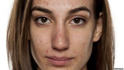 Akne Antibiyotik Kullanımı ve Faydaları Nelerdir?