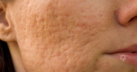 Akne Çukurları Oluşumunun Engellenmesi 