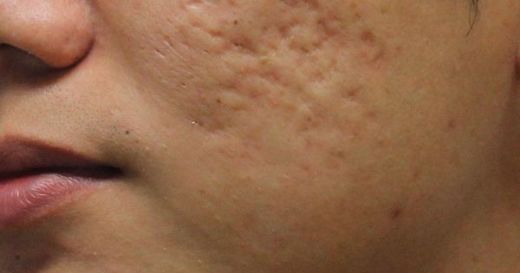 Akne Çukurları Nasıl Geçer? 