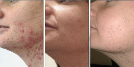 Akne Hapı Kullanımı ve Faydaları Nelerdir?