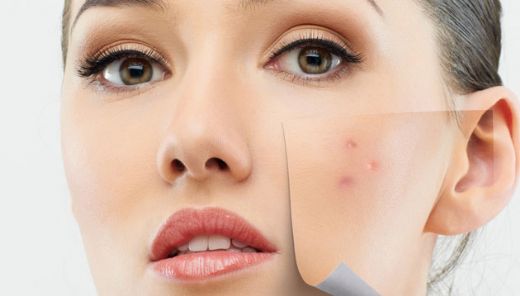 Akne Nedir? Belirtileri ve Tedavisi