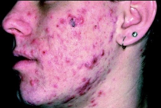 Akne Sivilce Tedavisi