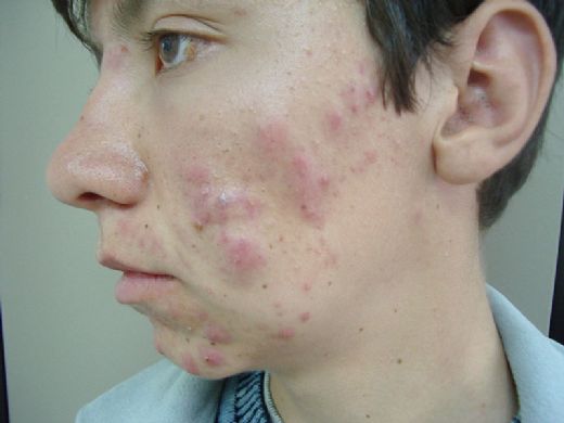 Akne Vulgaris Tedavisi