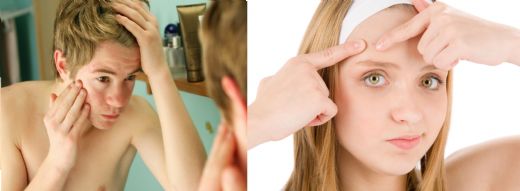 Anti Akne Kremi Kullanımı ve Faydaları Nelerdir?