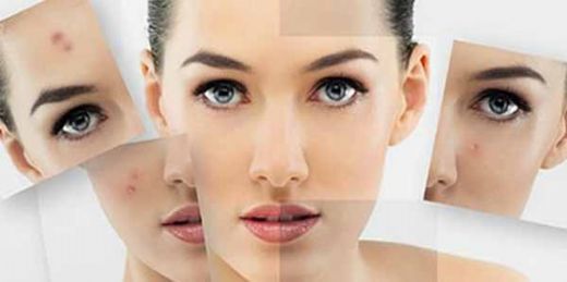 Bitkisel Akne Tedavisi