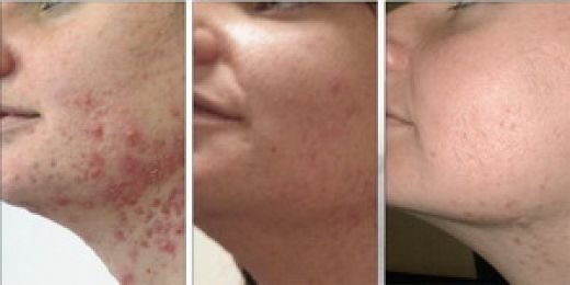 Lazerle Akne Tedavisi Lazerle Akne Nasıl Tedavi Edilir?