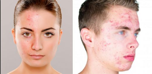 Sivilce Akne Kremi Kullanımı ve Faydaları Nelerdir?