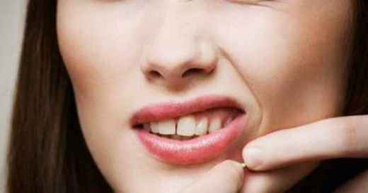 Yüzdeki Akneler Nasıl Geçer?