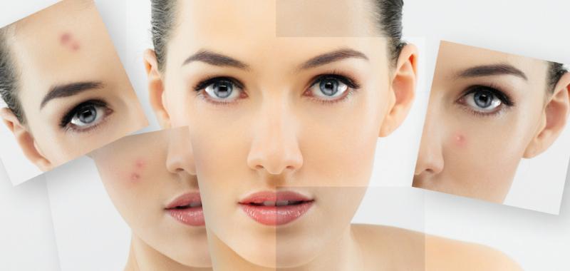 Akne İçin Krem Kullanımı ve Faydaları Nelerdir?