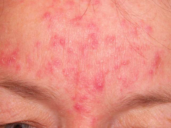 Akne Rozasea Belirtileri ve Tedavisi