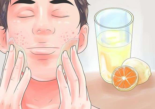 Yüzdeki Akneler Nasıl Geçer?